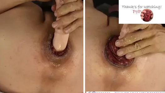 ada corona add anal prolapse fuck image