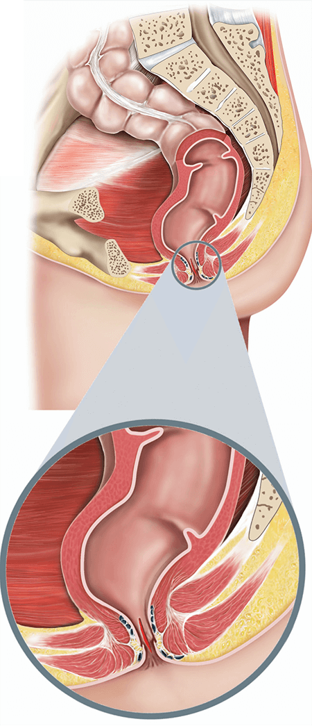 annie borja add anal pain face image